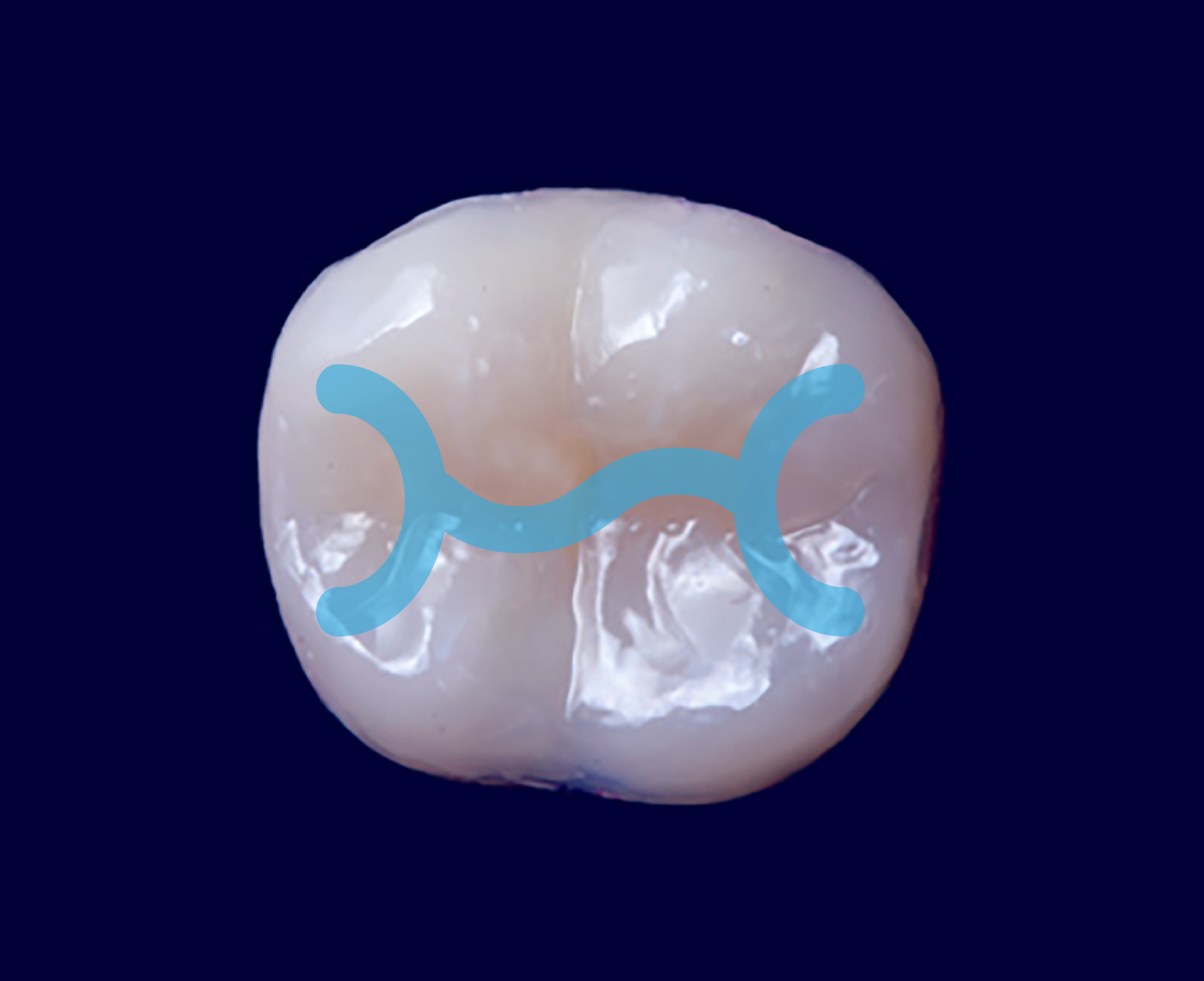 Top View of Molar Tooth