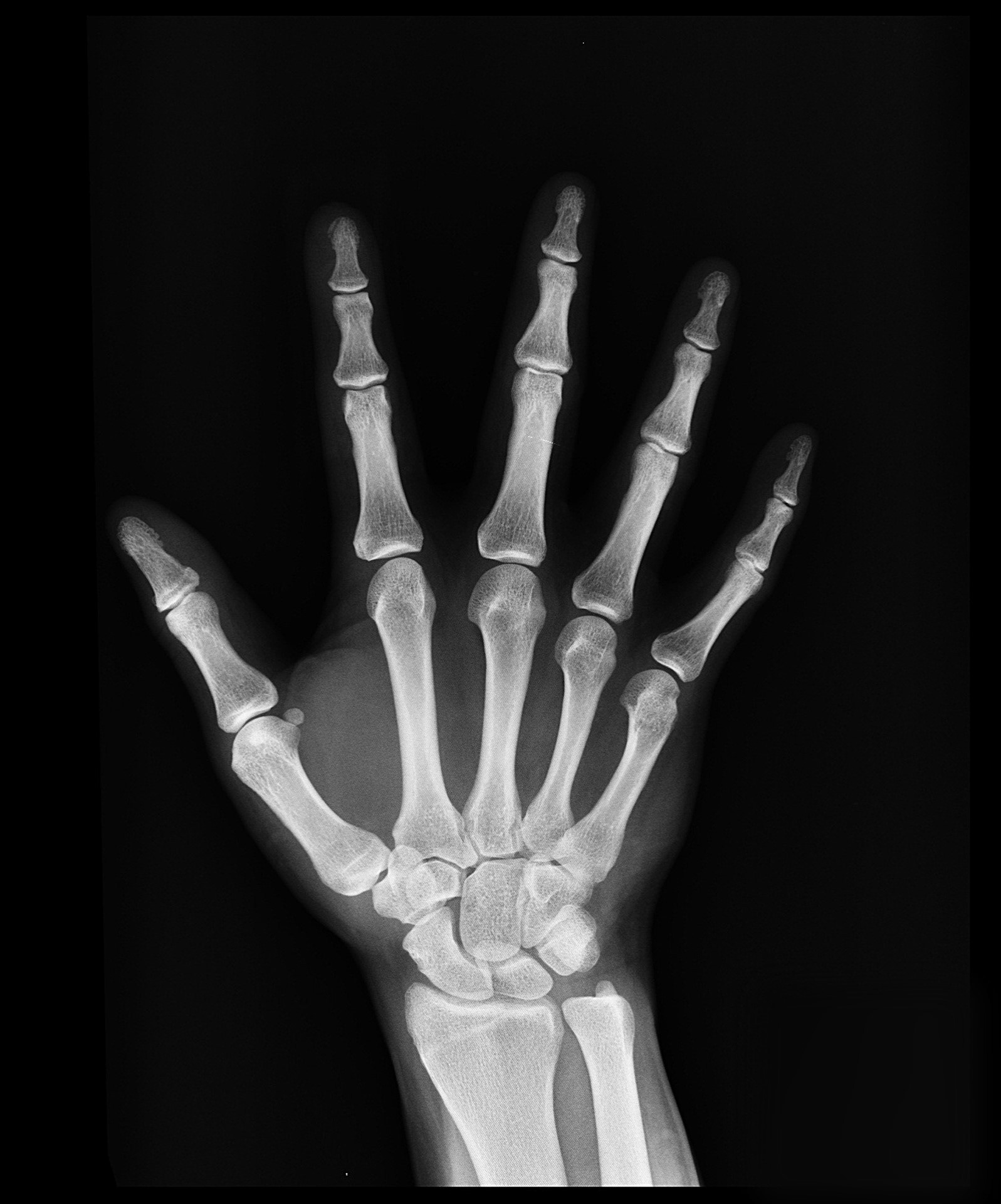 Hand X-Ray
