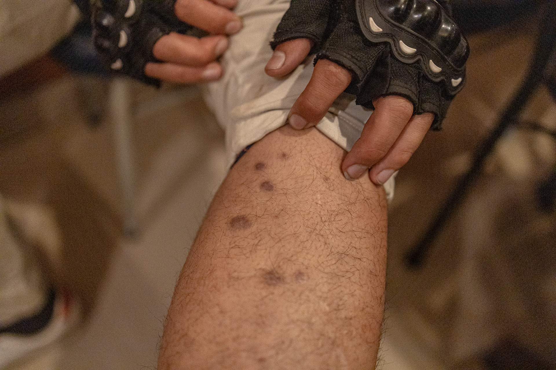Dawa Theeng, a former recruit who was injured near Bakhmut, shows wounds sustained during fighting after being sent to the front in Ukraine.