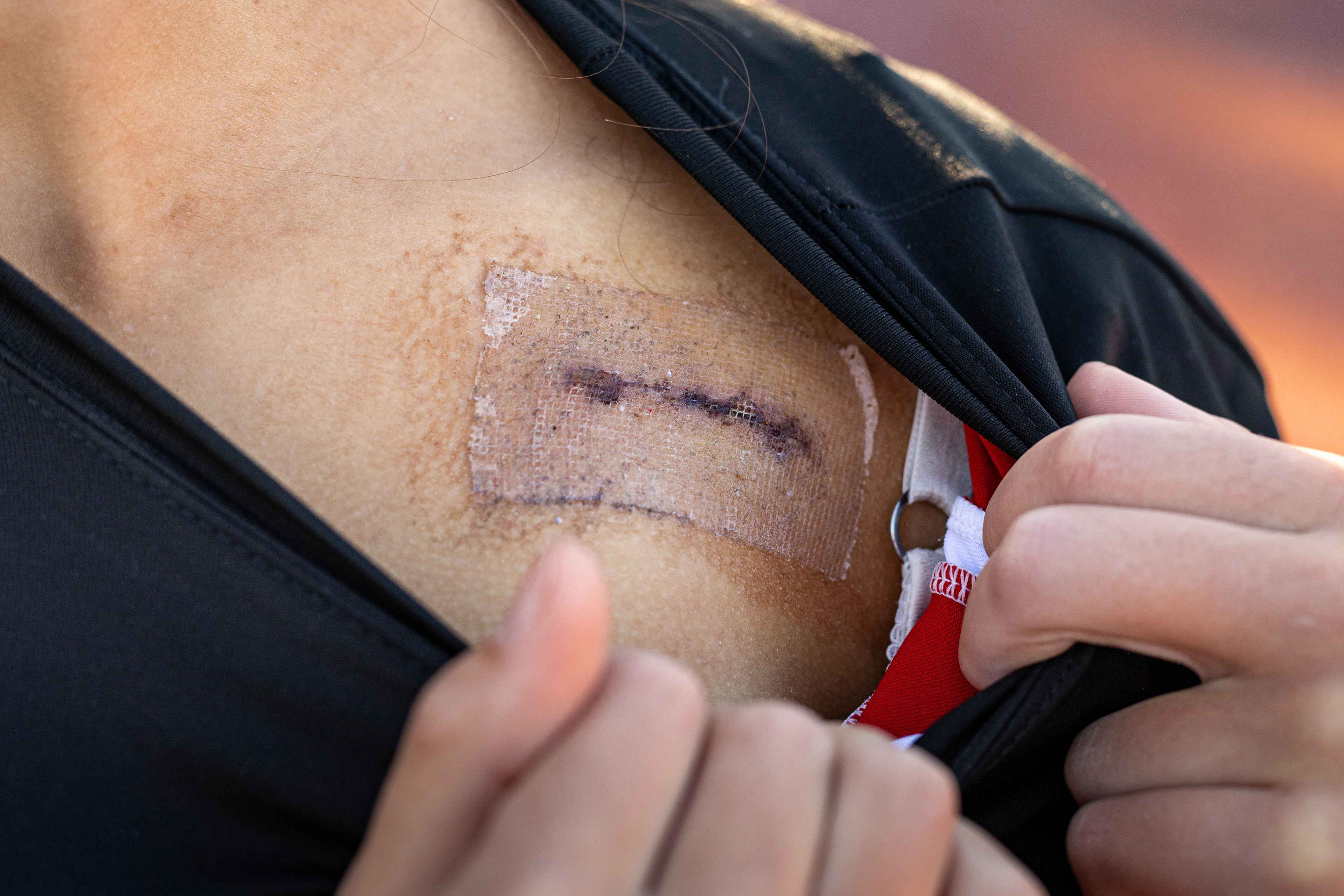 Abbey shows her scar from an implantable cardioverter defibrillator (ICD) that was surgically placed in October. Abbey was diagnosed with a rare, but potentially lethal, inherited cardiac condition that causes sudden rhythm disturbances which are monitored and corrected by the ICD.