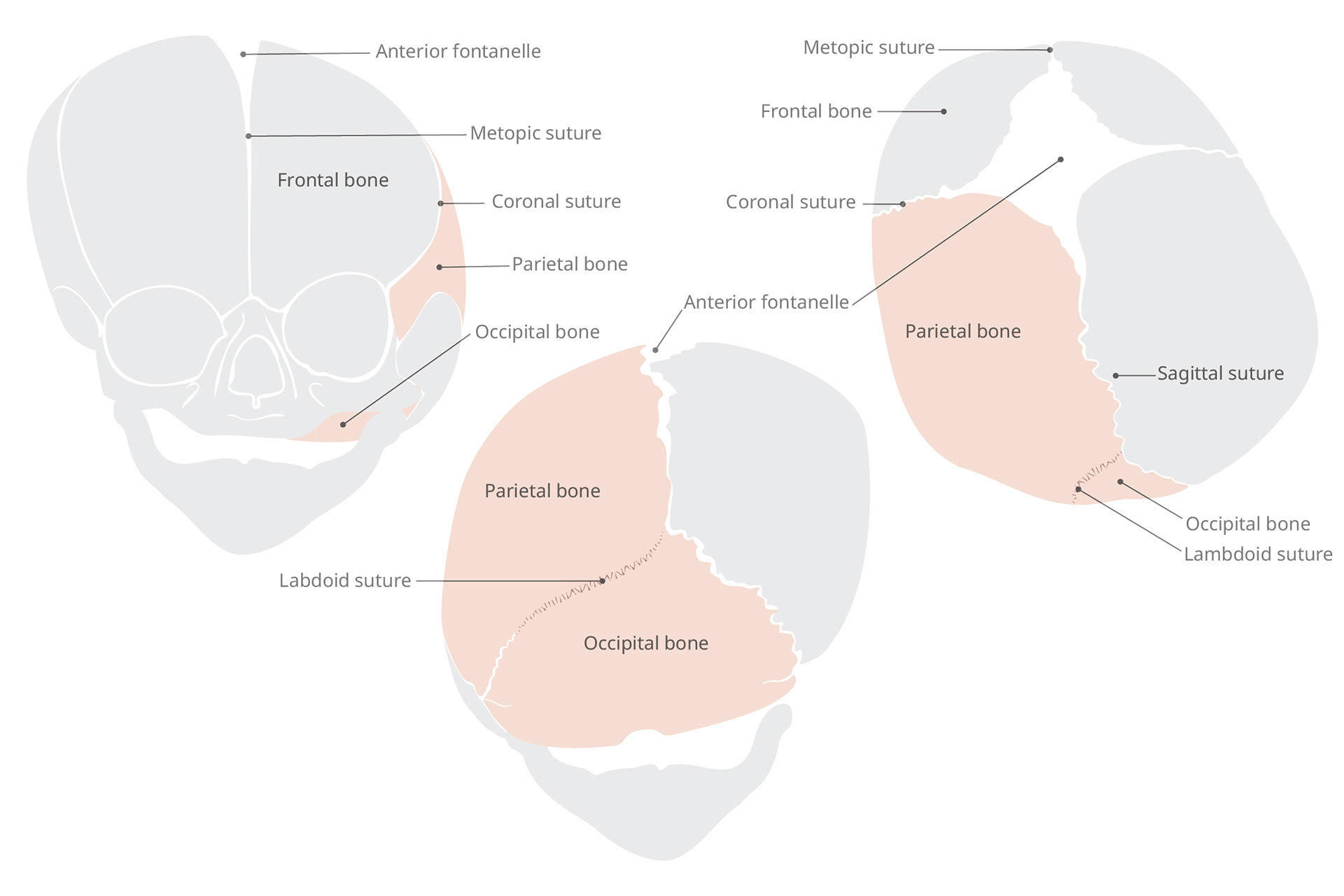 Cranio Anomaly -Lambdoid Suture