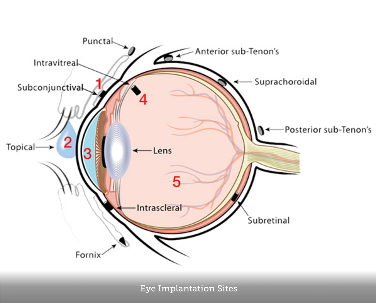 Eye implants