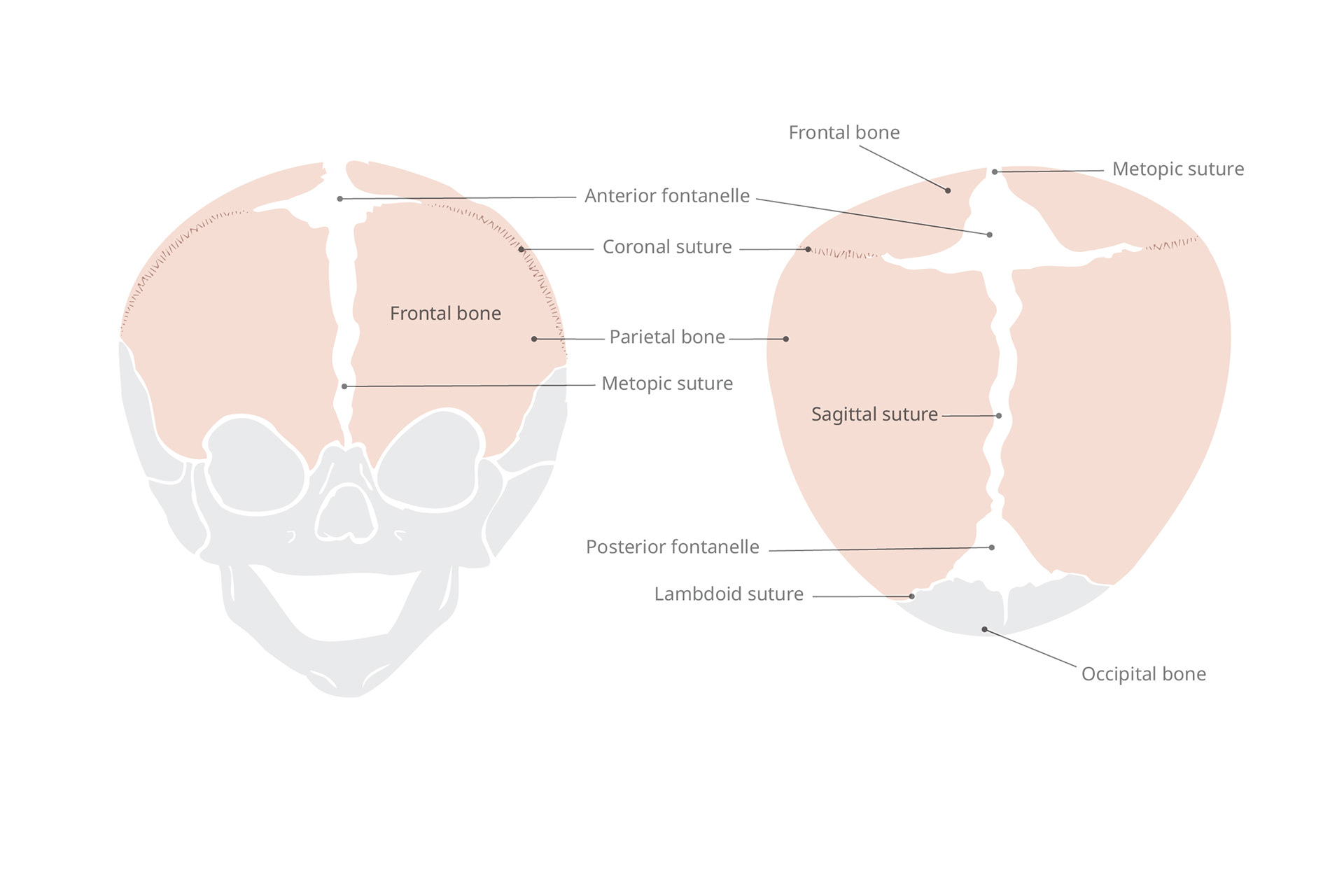 Cranio Anomaly - BiCoronal Suture