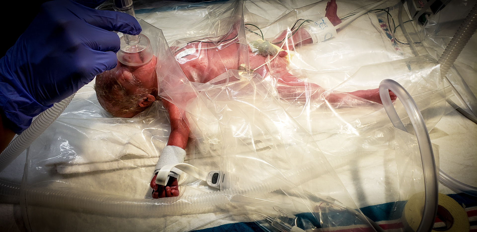 27 weeks 3 days gestation, 90 days early ~ 2 pounds 4 oz. with a long road ahead