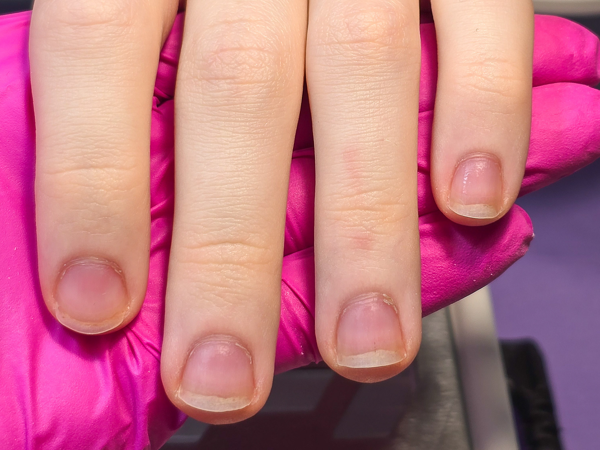 PŘED je stav před dnešní návštěvou – úplné začátky bohužel nafocené nemám. Před cca 3 měsíci to ale byly výrazně kousané nehty. Díky pravidelné údržbě je dnes krásně vidět, jak dorůstá nehet i nehtové lůžko a kousání je minulostí.