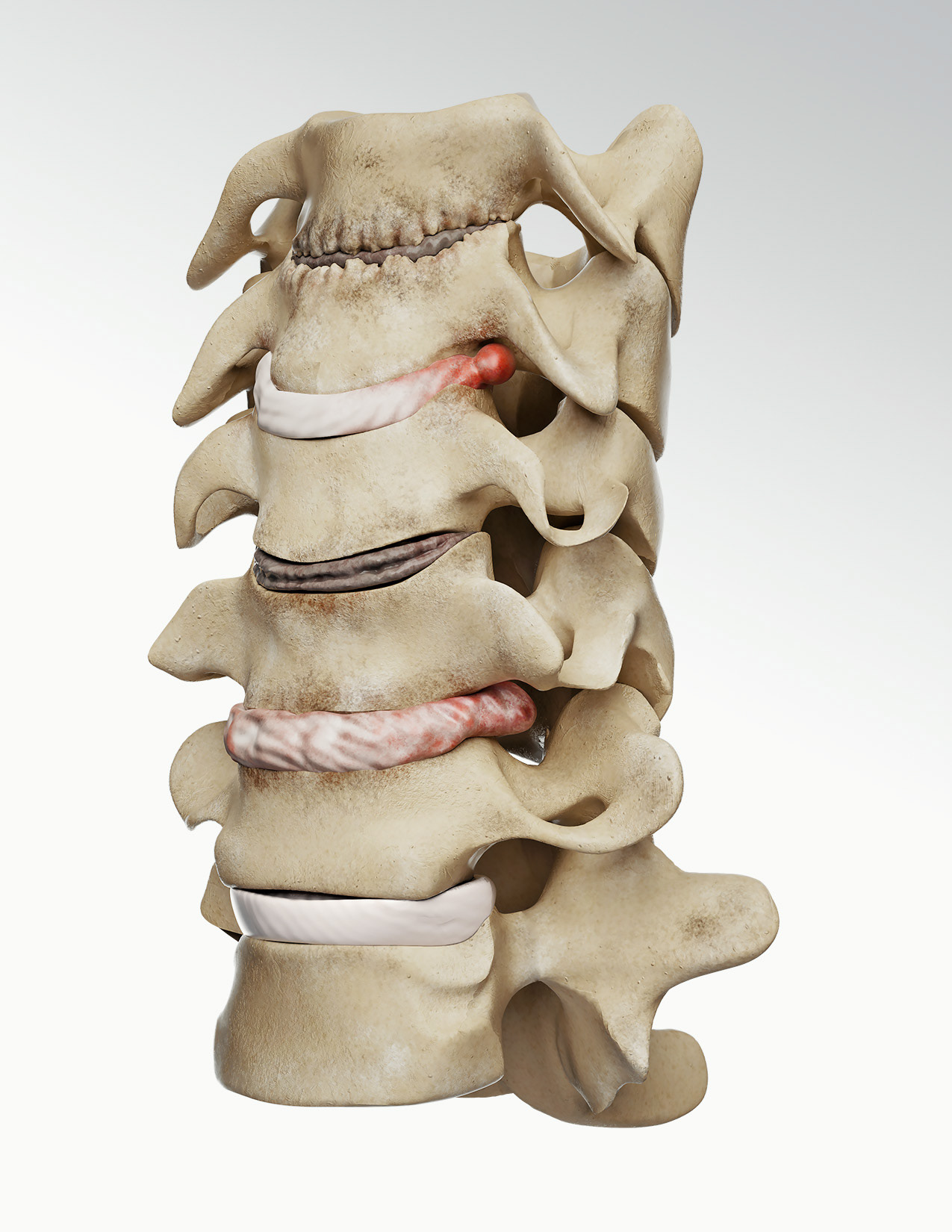 Cervical disc degenerations