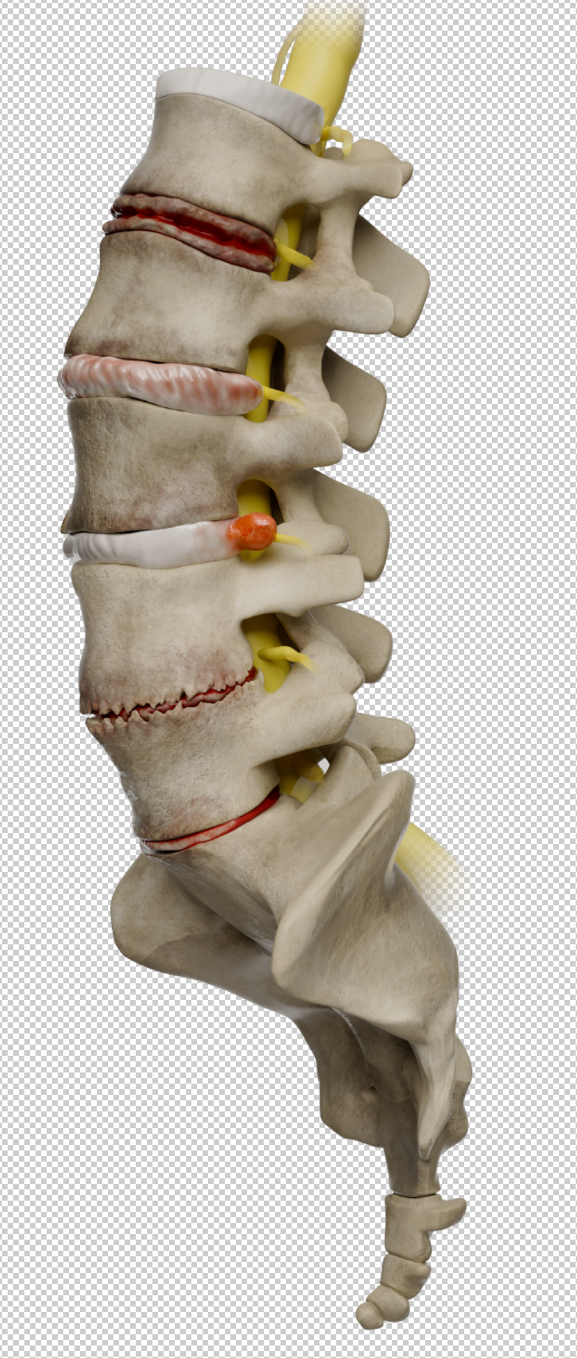 Lumbar disc degenerations