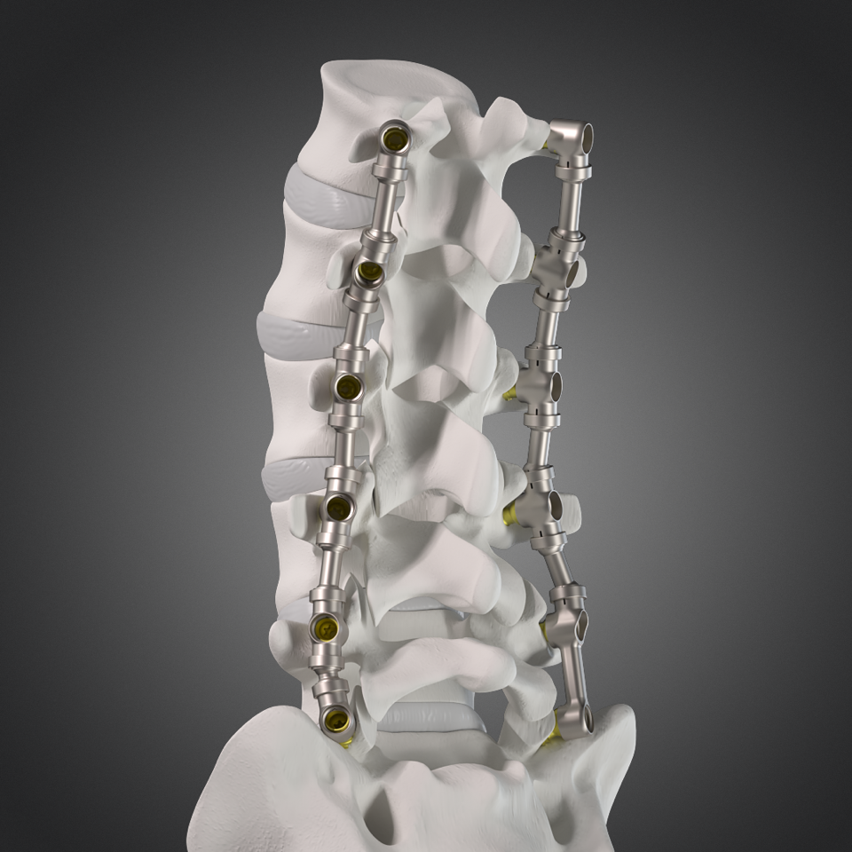 Multilevel spinal fusion