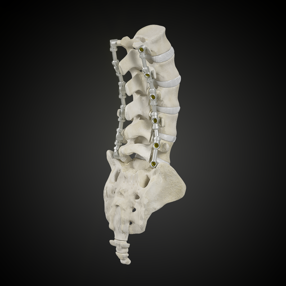 Multilevel spinal fusion
