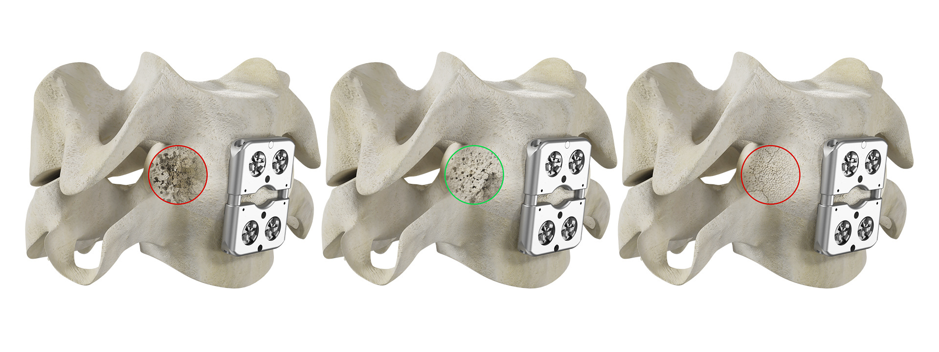 Bone density simulation - comparison