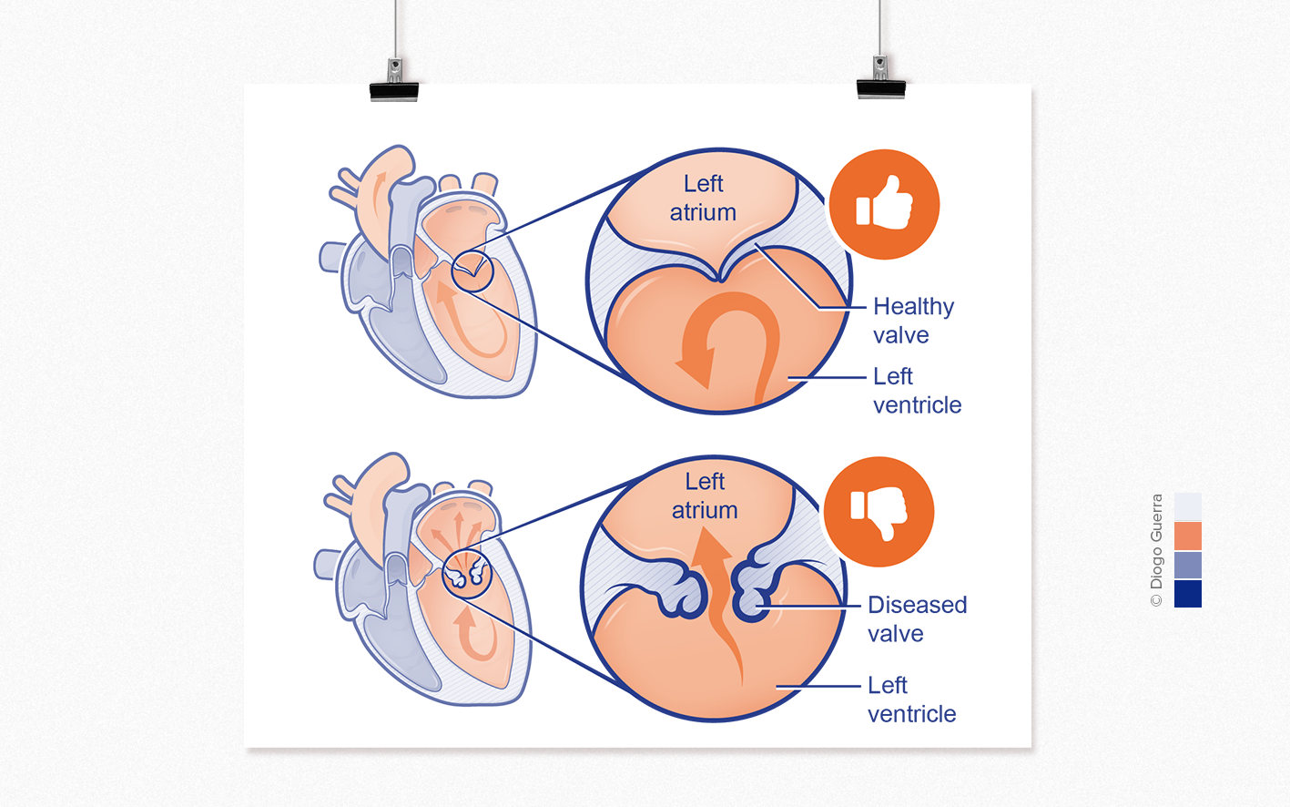 anatomical alterations in the mitral valve – myxomatous mitral valve disease in dogs.