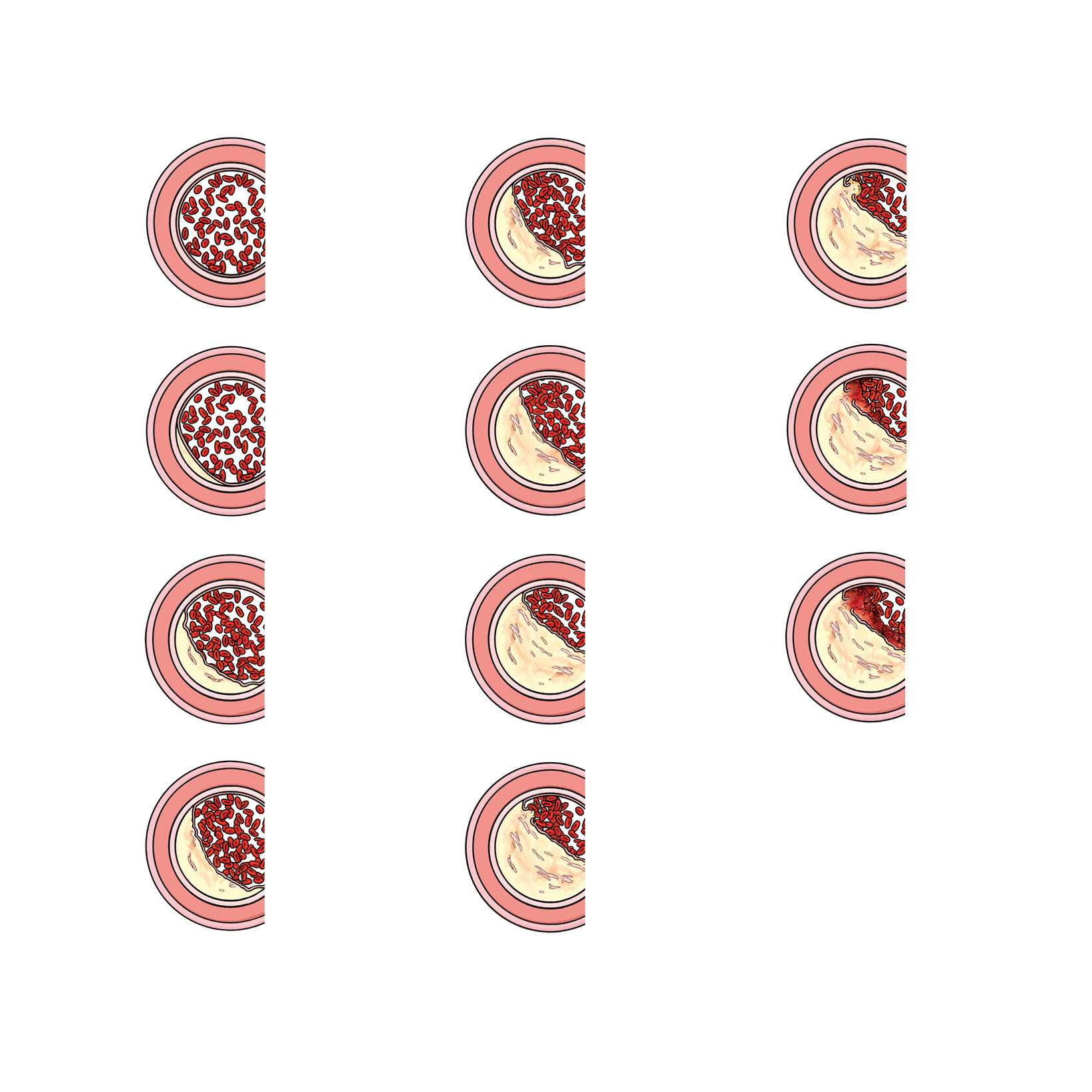 De hoofdstuk aanduiding illustratie:progressie van atherosclerose