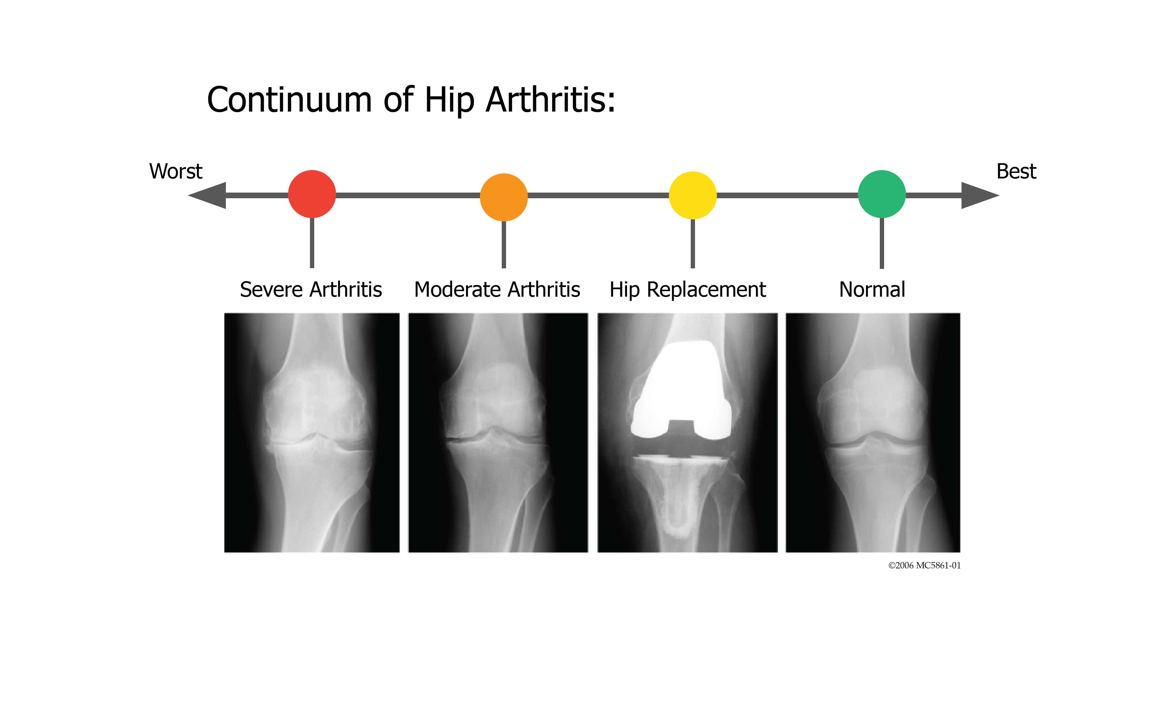 This image helps patients understand that their new hip will never be like a healthy normal hip.