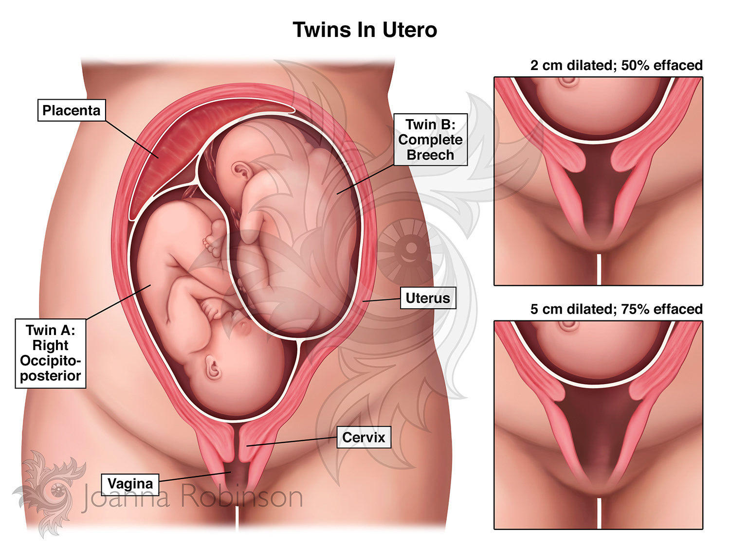 Positioning of twins with comparison illustrations of case-specific dilation and effacement measurements. Photoshop. © The Evidence Store
