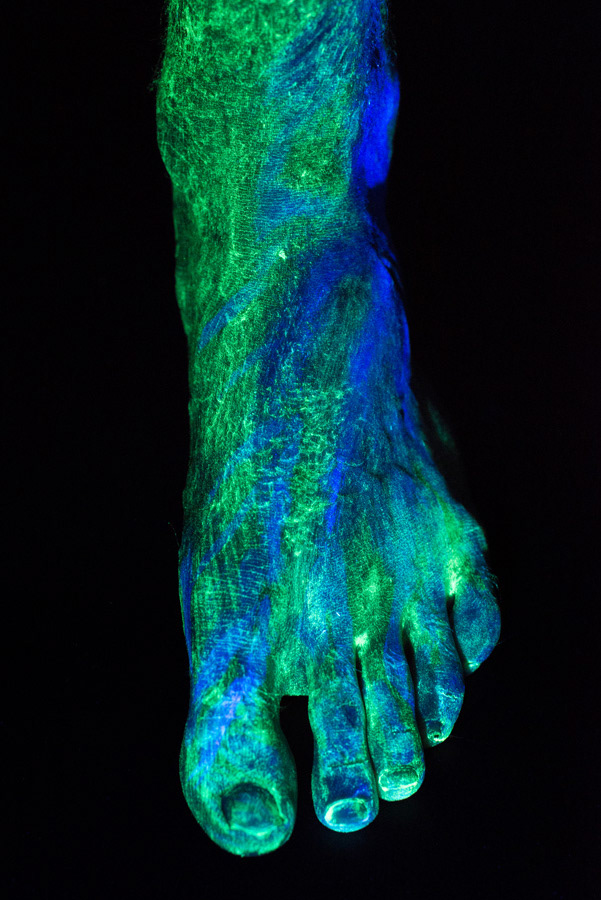 - Où en es-tu dans ton parcours de guérison ? - Pour être honnête, je suis encore frustré par rapport aux choses que je peux ou pas accomplir, avec ce poids mort, littéralement,... C’est une barre de titane. Je dois faire un effort particulier, mais fnalement, il y a quand-même de belles choses qui en résultent.