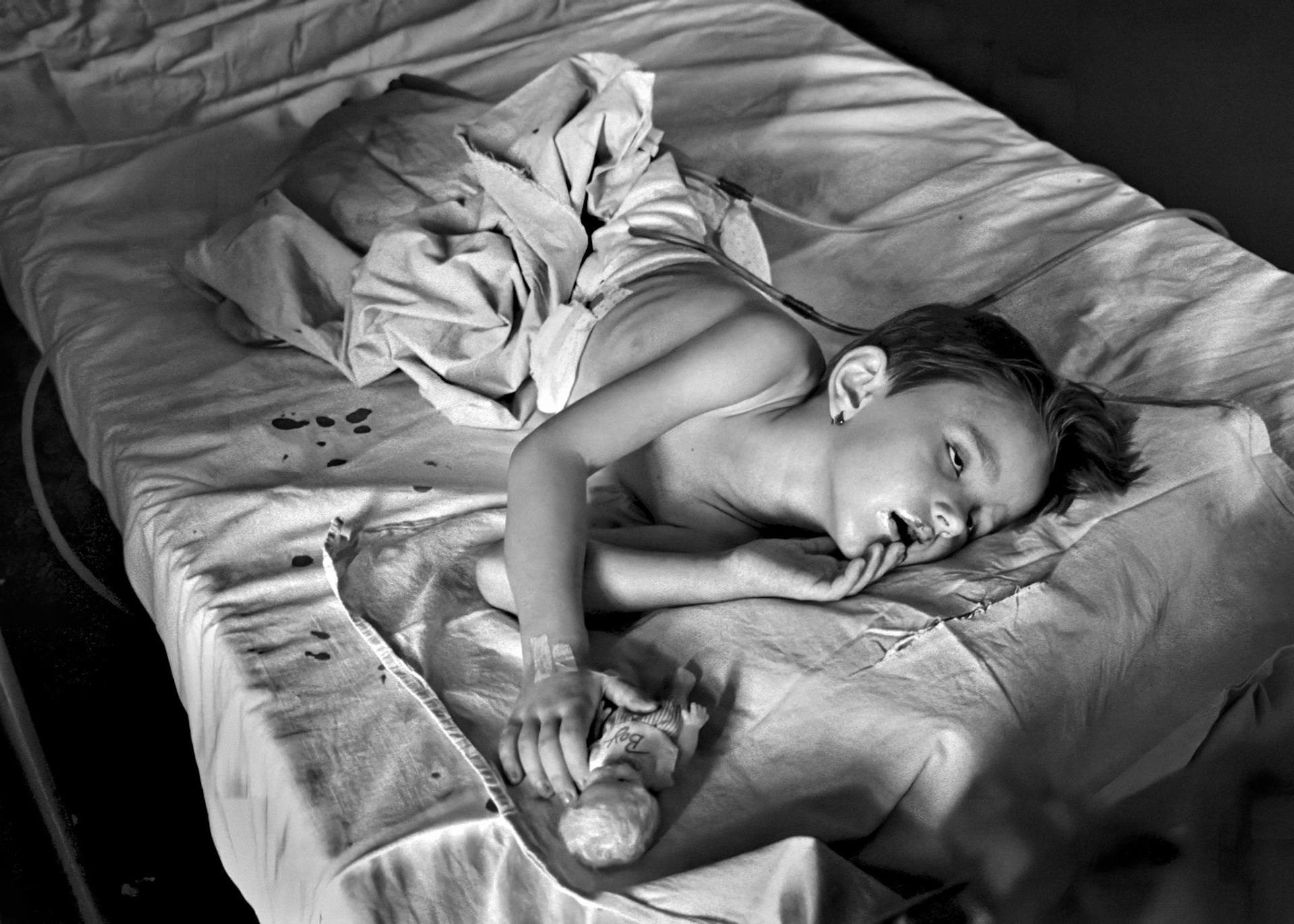 Five-year-old Irma Hadzimuratovic lies seriously injured in a Sarajevo hospitial on August 5 1993. She was injured by a Bosnian Serb mortar shell 6 days ago which killed her mother and 14 others in a market square in Bosnia's capital, Sarajevo.