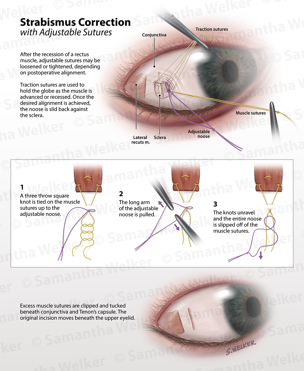 Samantha Welker - Strabismus Correction Samantha Welker - Strabismus Correction