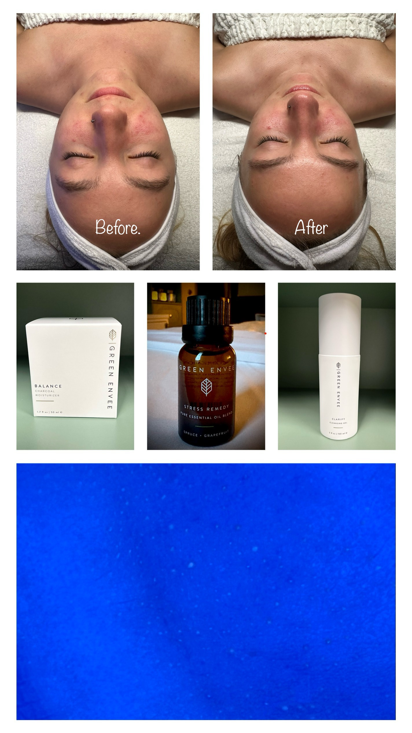 Acne + Inflammation Treatment