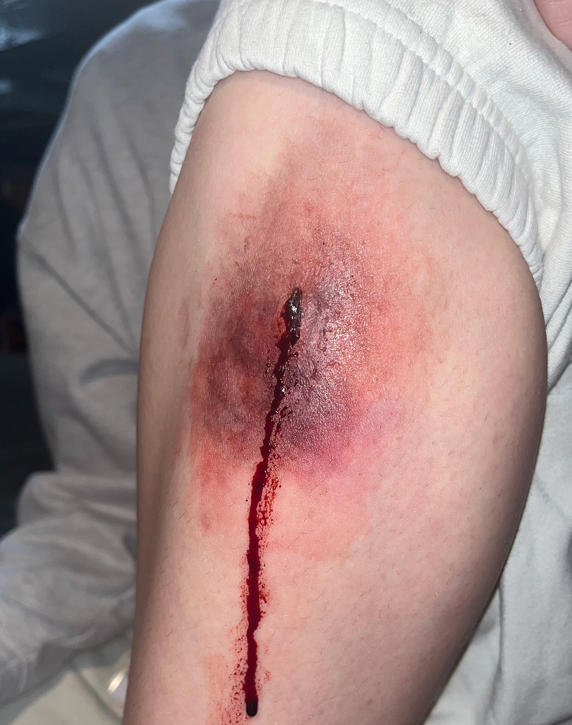 'Deep Leg Incision'