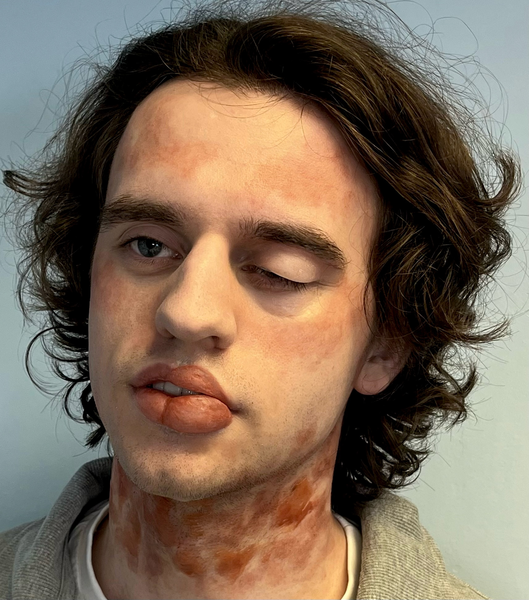 'Anaphylaxis Stage 4'