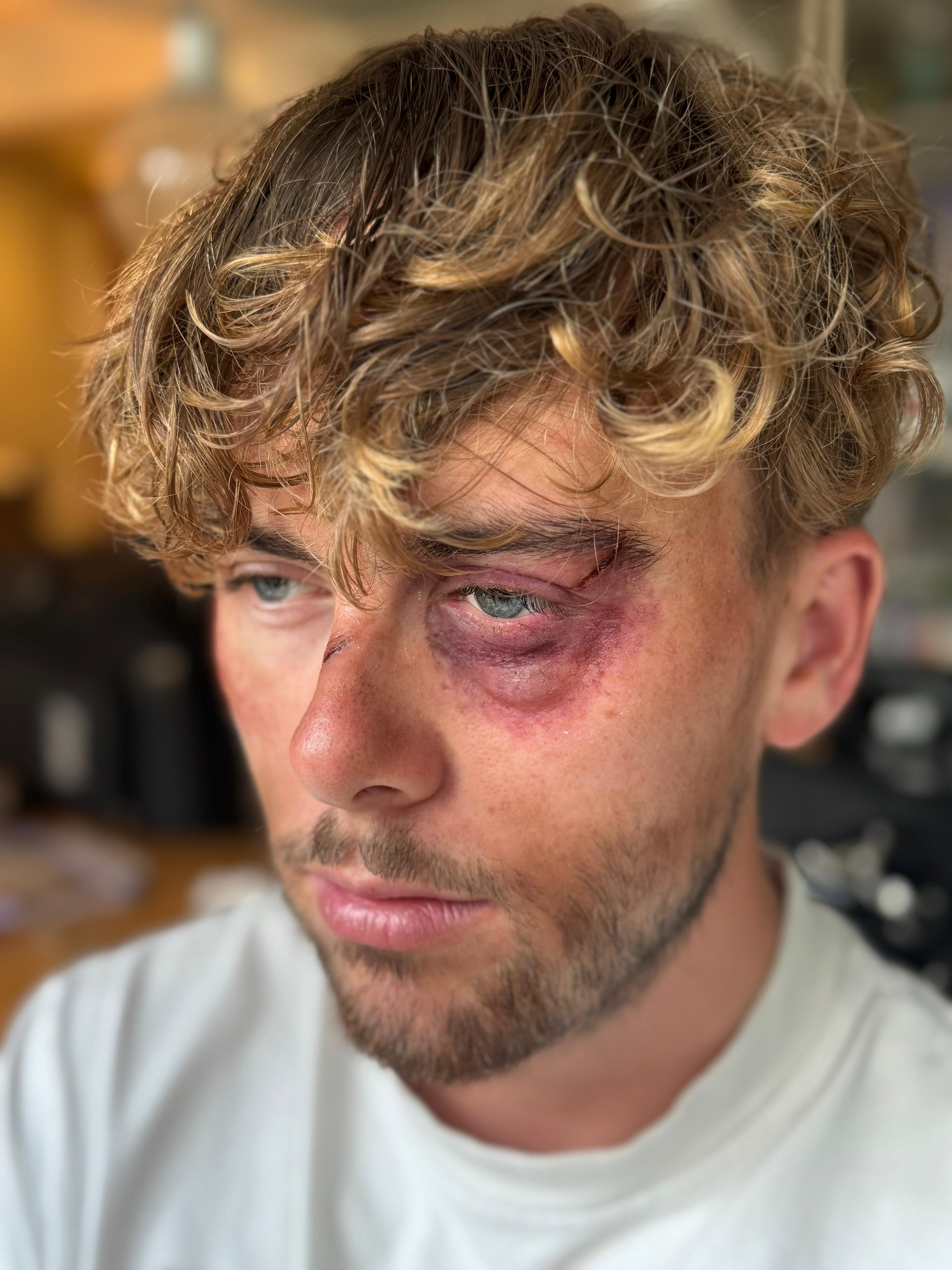 'Swollen Black Eye' 2025