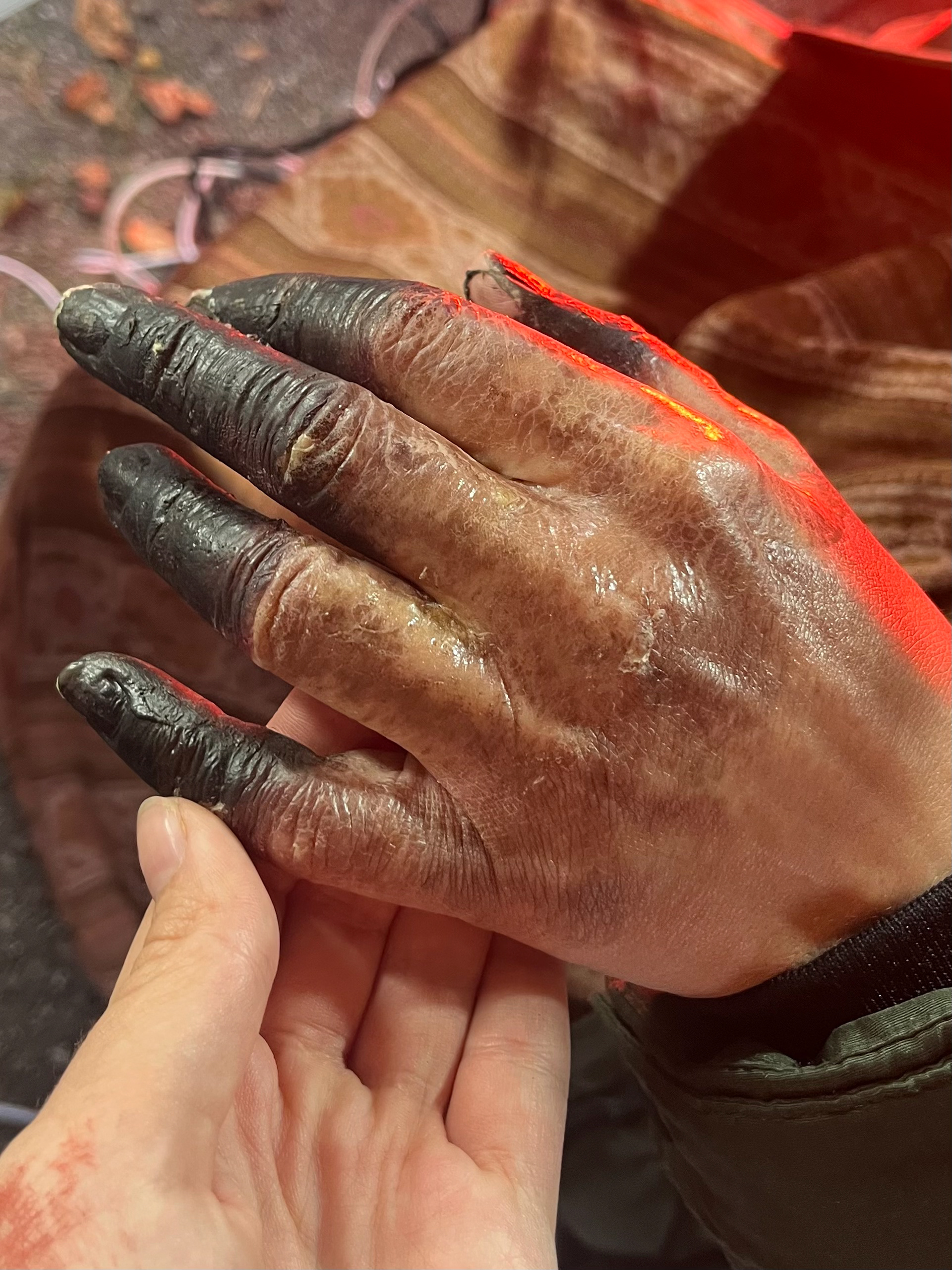 Gangrene hand - applied on cast by Ruby Hall & Sophia Marie Davison