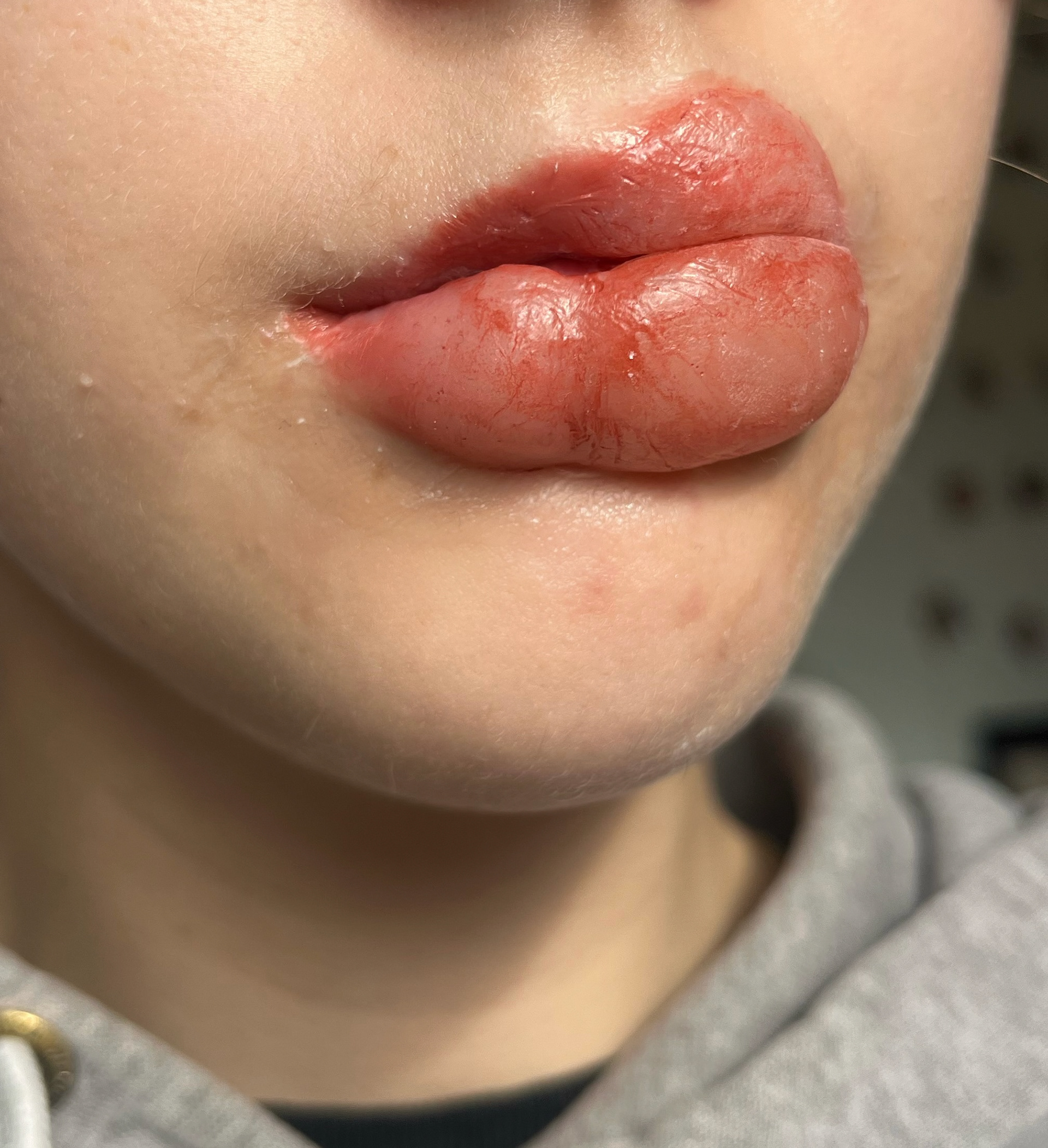 Anaphylaxis Lip Test