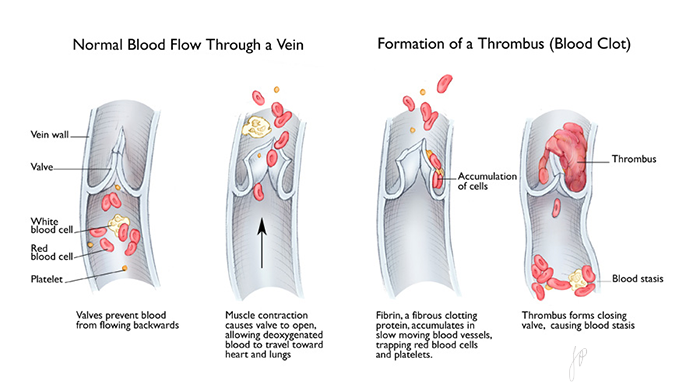 "Venous Thrombus" Watercolor