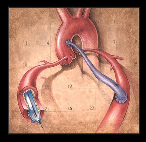 "Angioplasty vs. Bypass" Colored pencil and photoshop