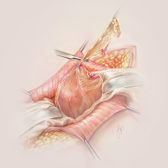 "Appendectomy" Adobe Photoshop