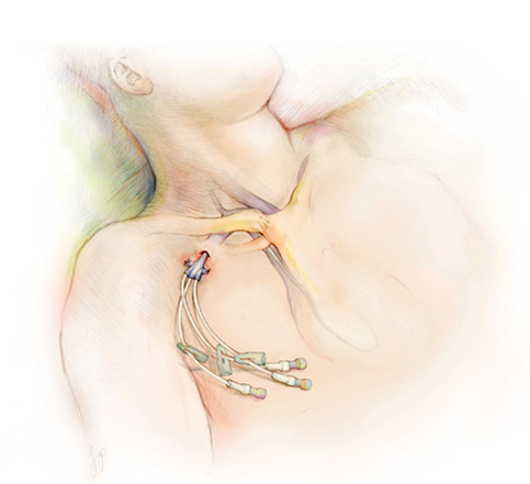 "Intravenous Therapy" Adobe Photoshop