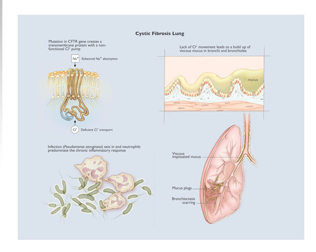 "Cystic Fibrosis Lung" Photoshop