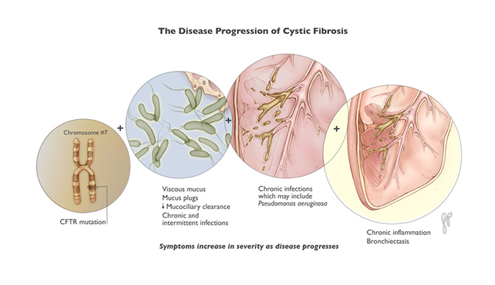 "Disease Progression of Cystic Fibrosis" PHotoshop