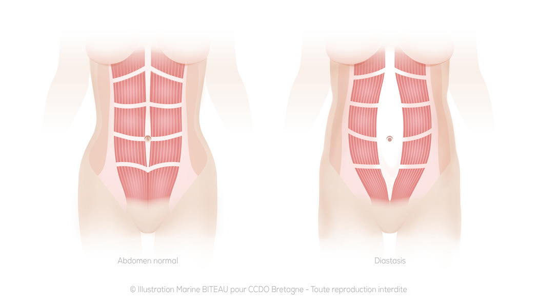 © CCDO Bretagne - Diastasis (étirement trop important des muscles de l'abdomen)