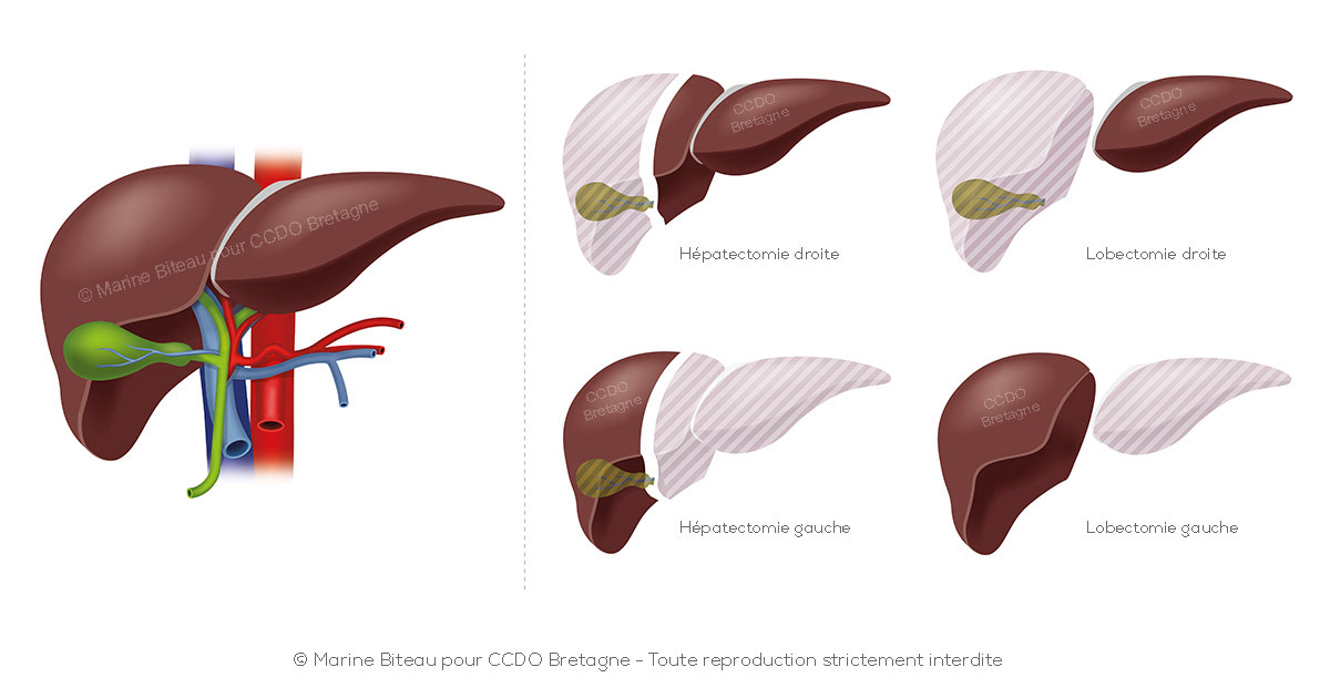 © CCDO Bretagne - Foie sain VS foie malade subissant soit une hepatectomie ou lobectomie