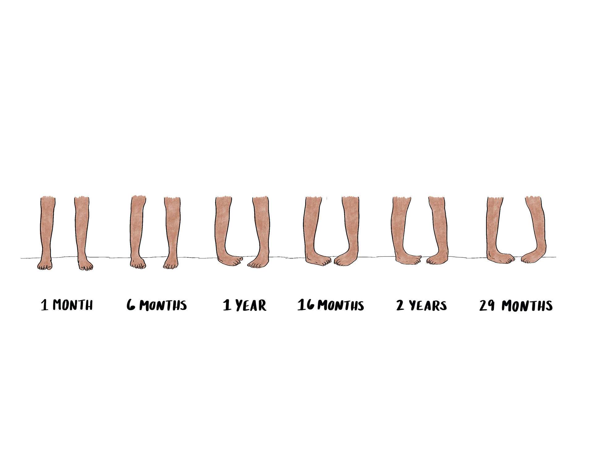 Progression of Feet (no brace)
