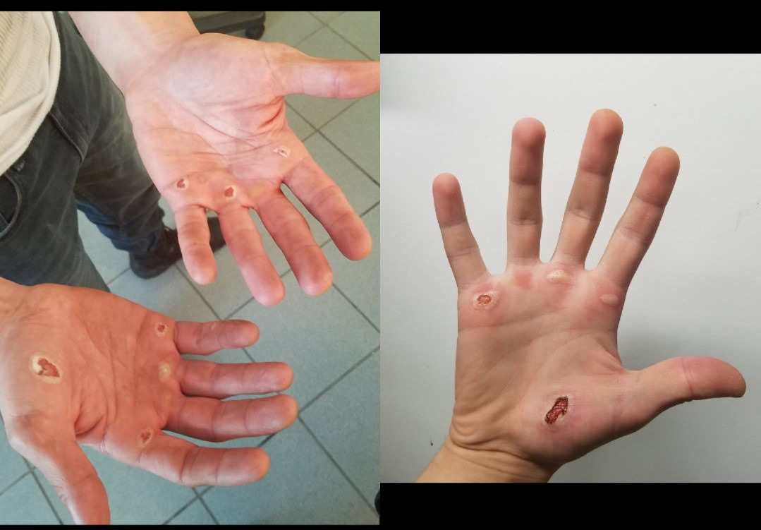 Blisters. The Punisher season 1