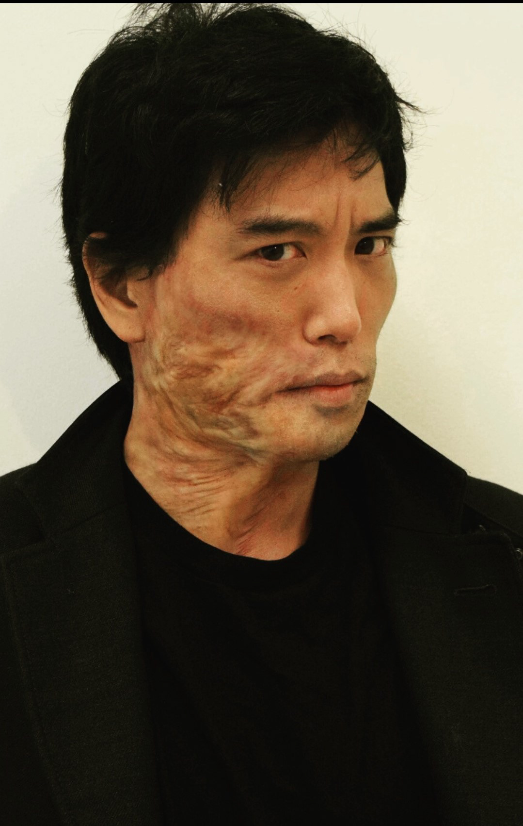 "Nobvu" healing burn scar. Daredevil season 2