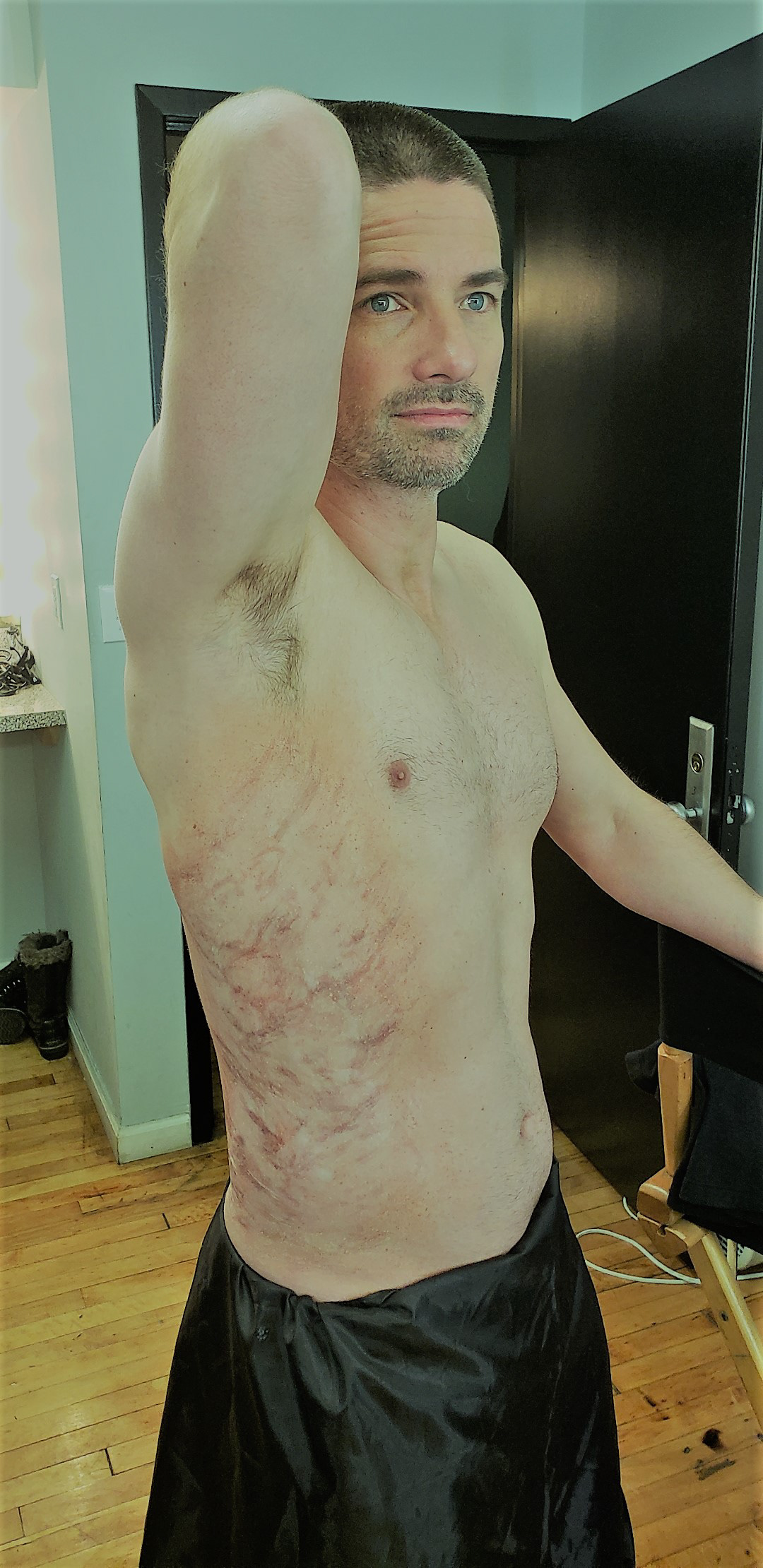 Burn Scar from Upcoming NBC show, The Village