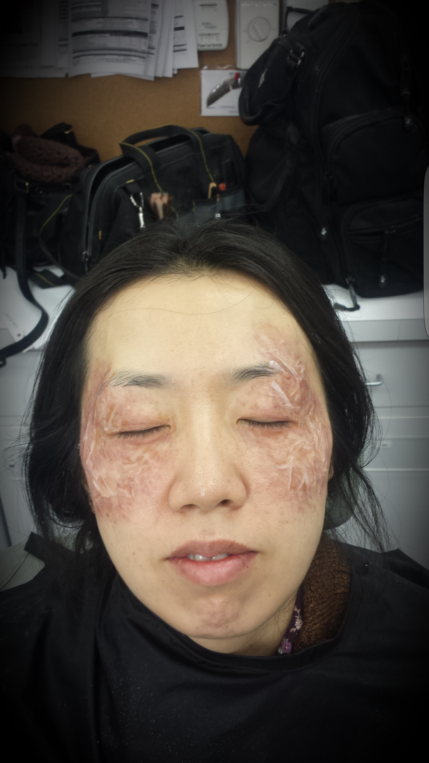 Acid burn scars