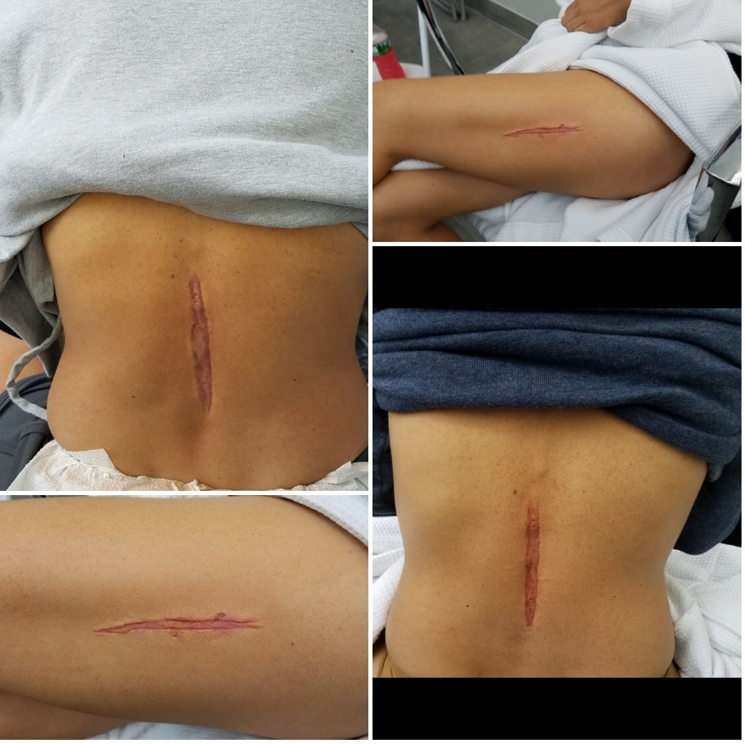 "Krista" scars fro The Punisher S2