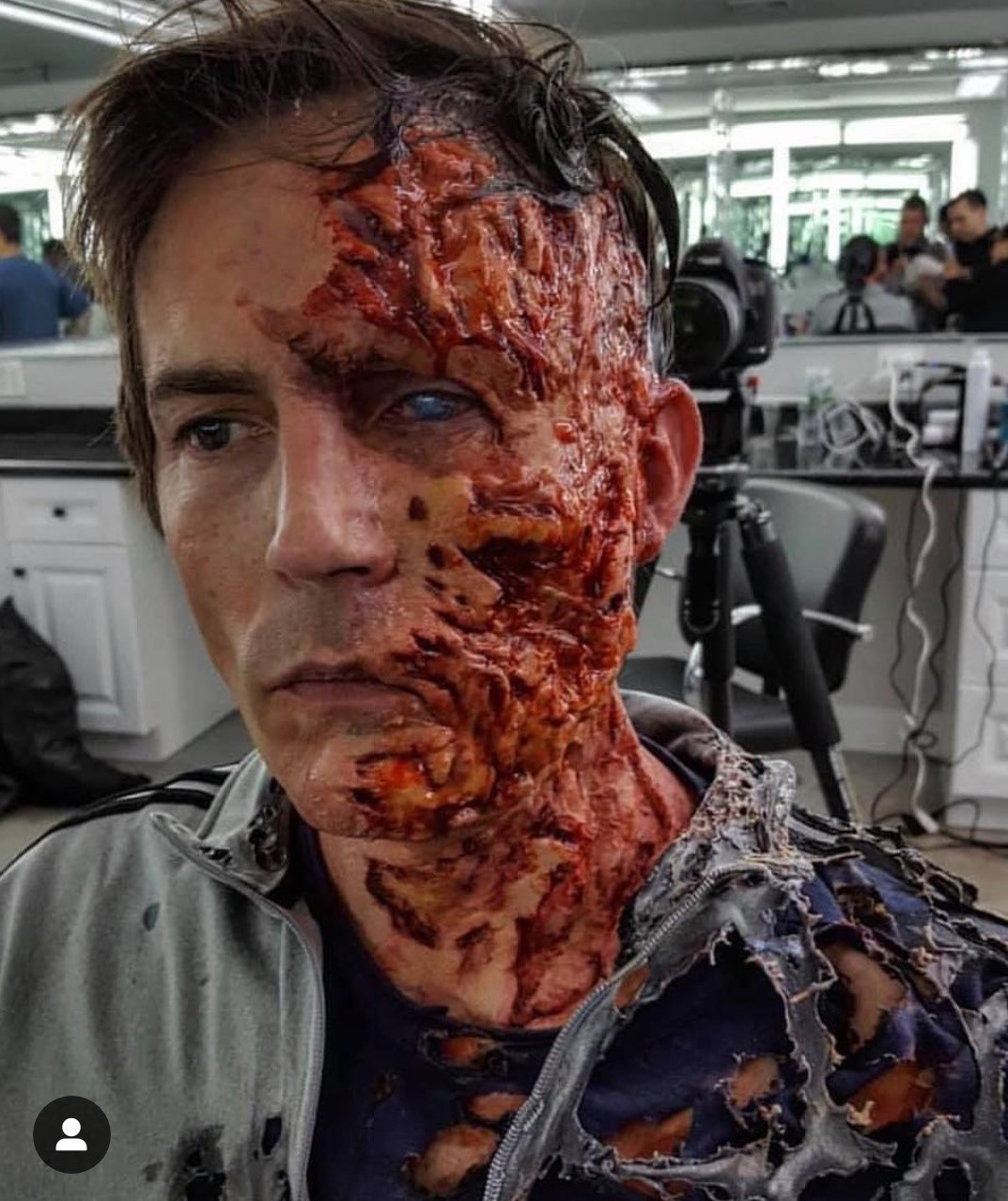 Acid burn from "Sneaky Pete"