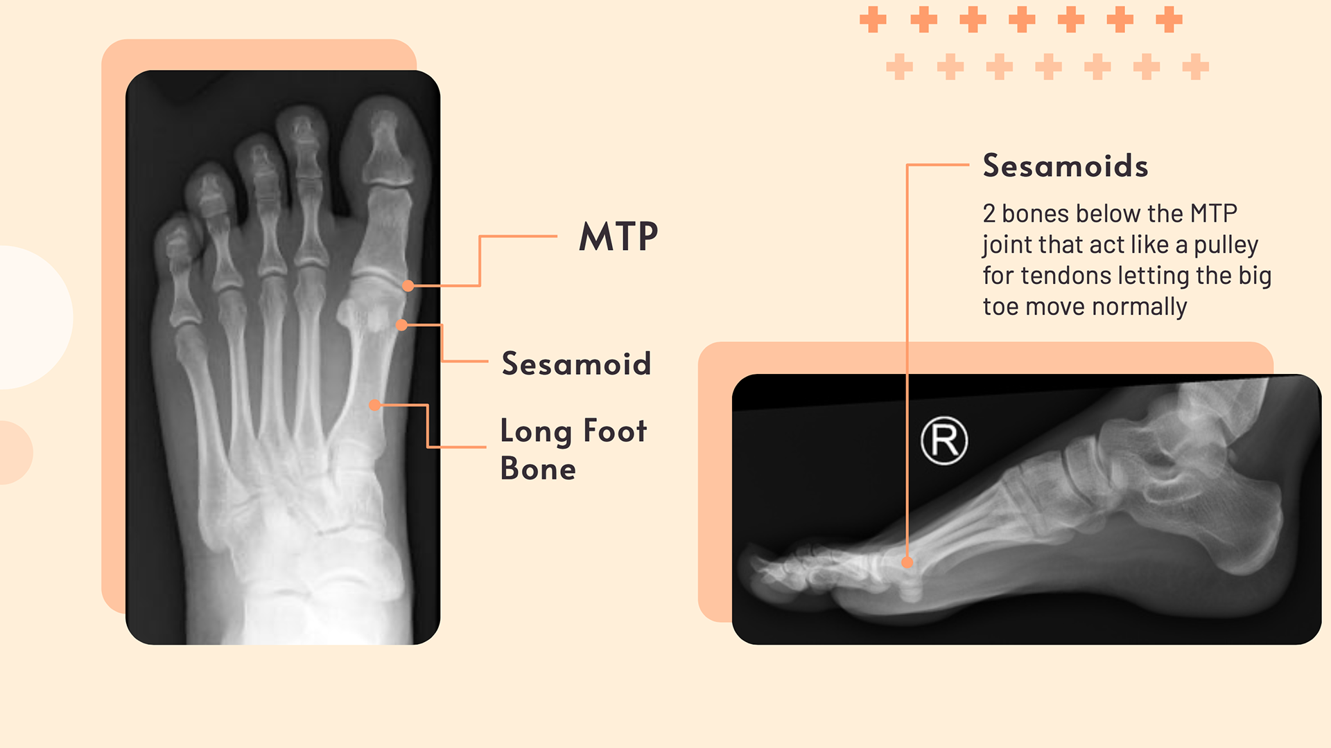 X-ray of Human Foot