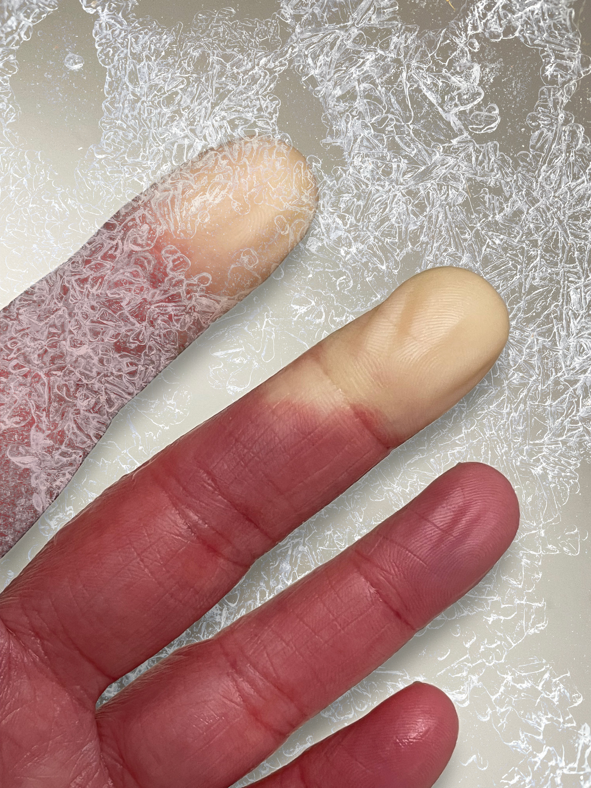 Vasospasm/Raynaud's Syndrome -- 2024