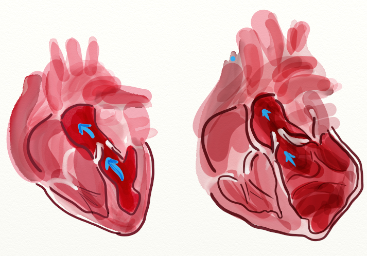 Dilated Cardiomyopathy