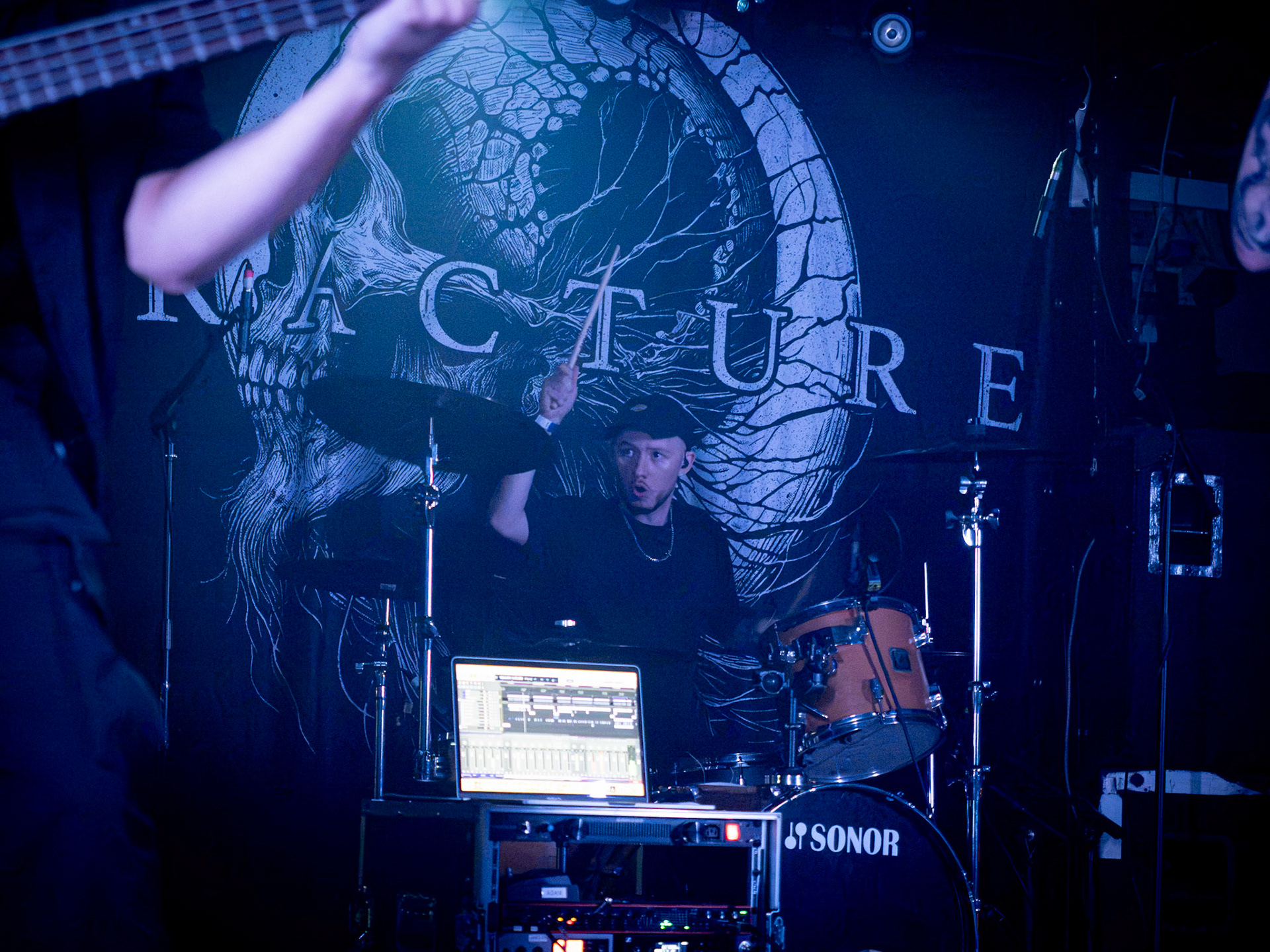 Fracture