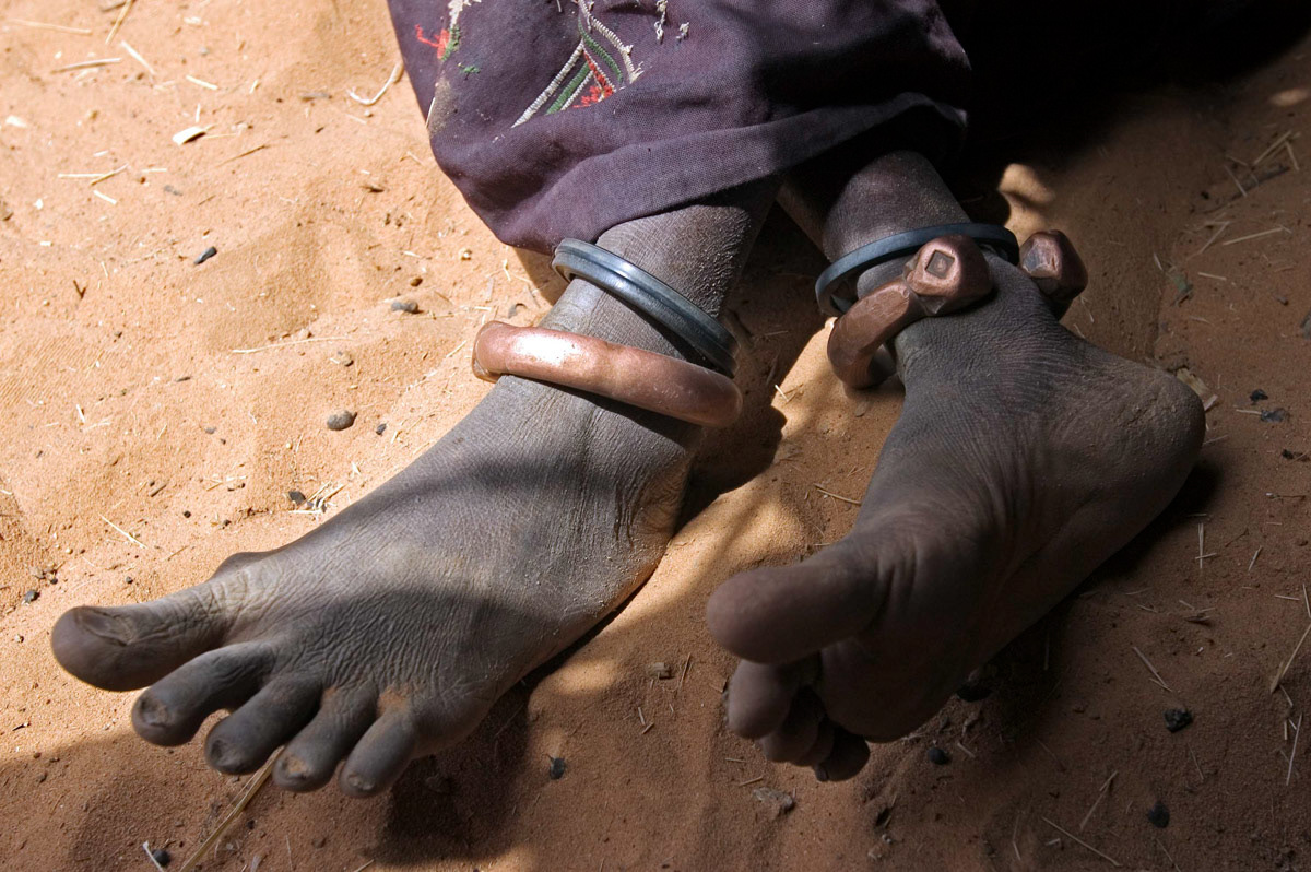 Signs of slavery; special anklets that indicate the slave caste. Niger.