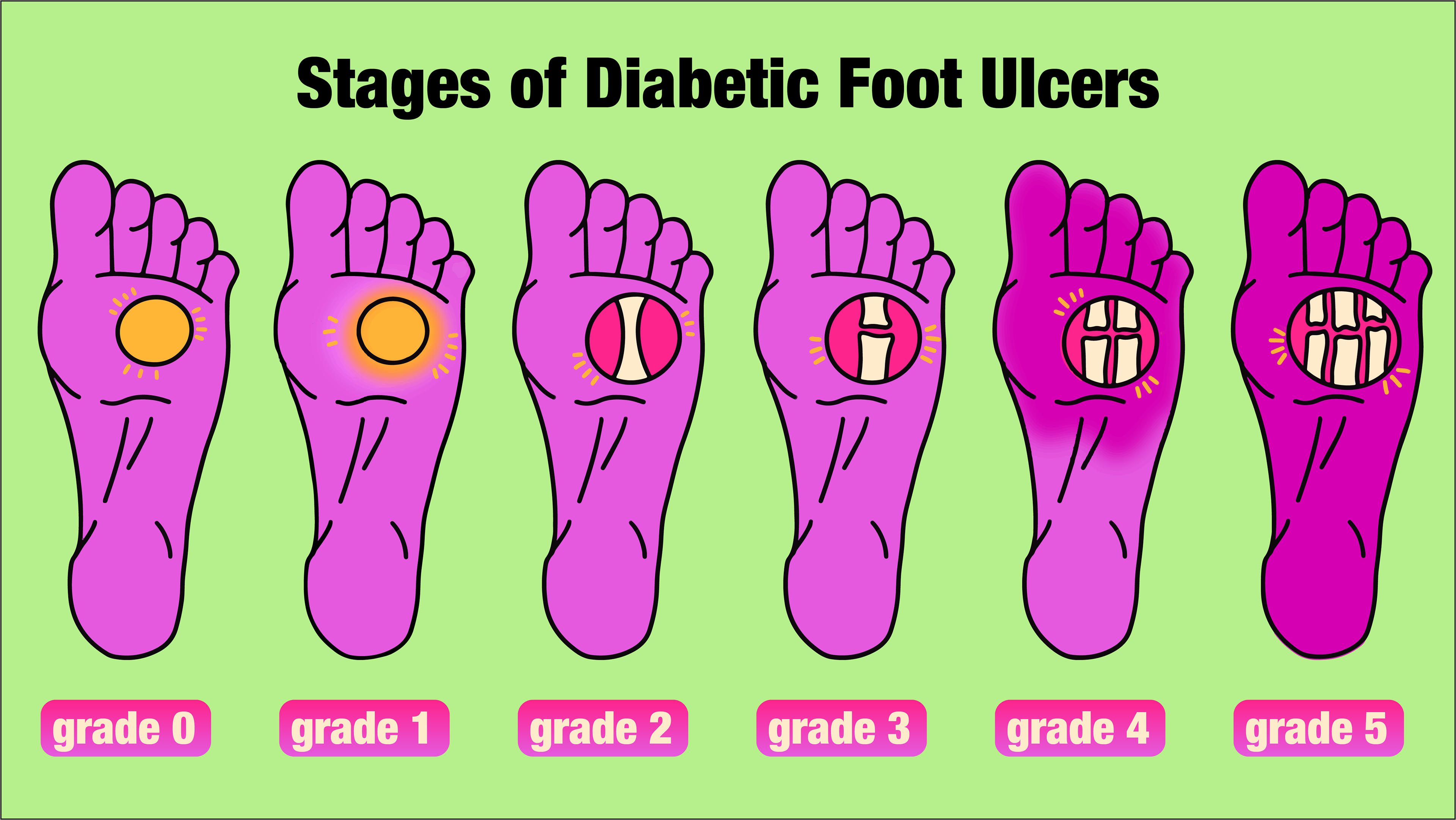 Stages of Diabetic Foot Ulcers