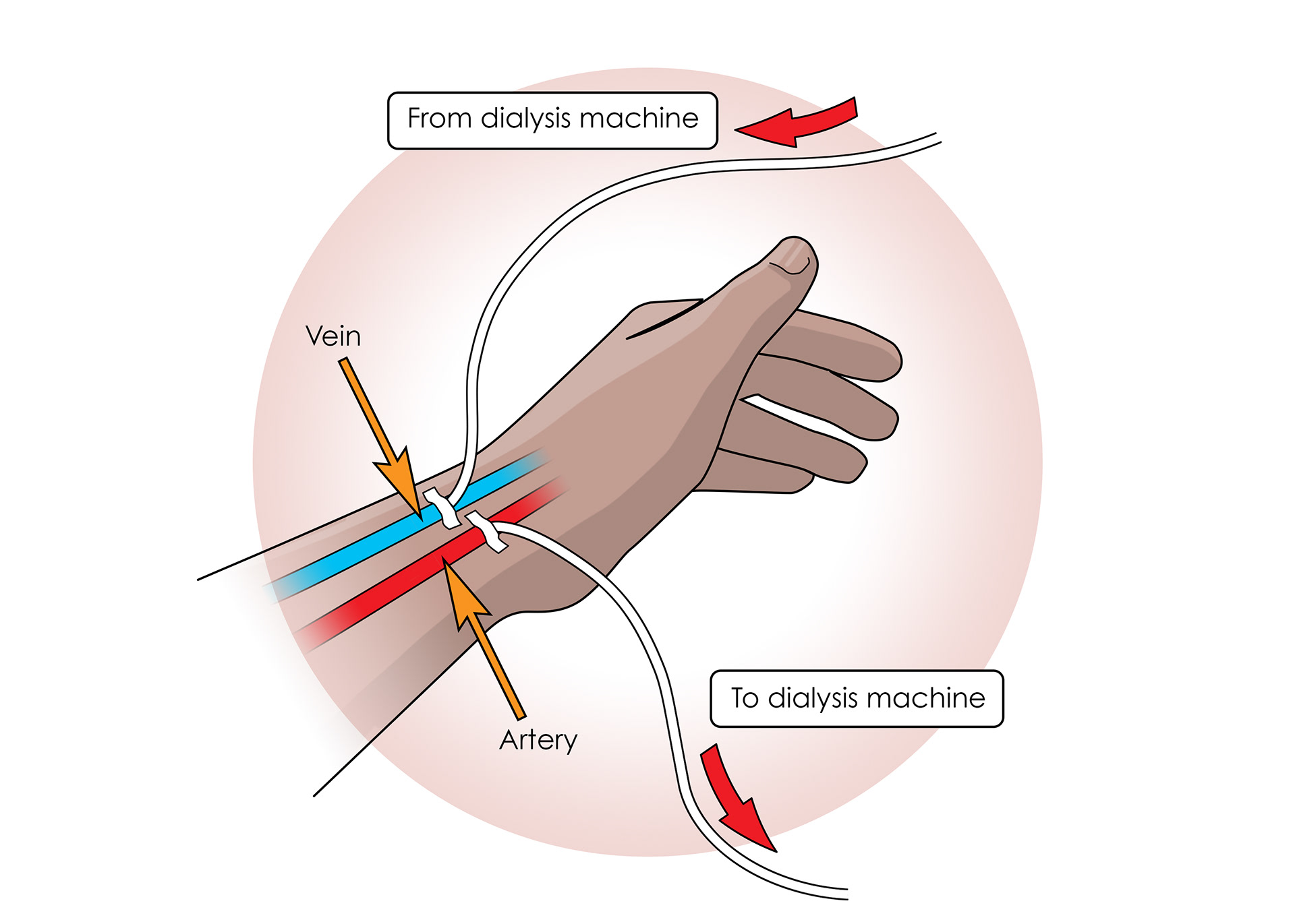 Patients are connected via arteries