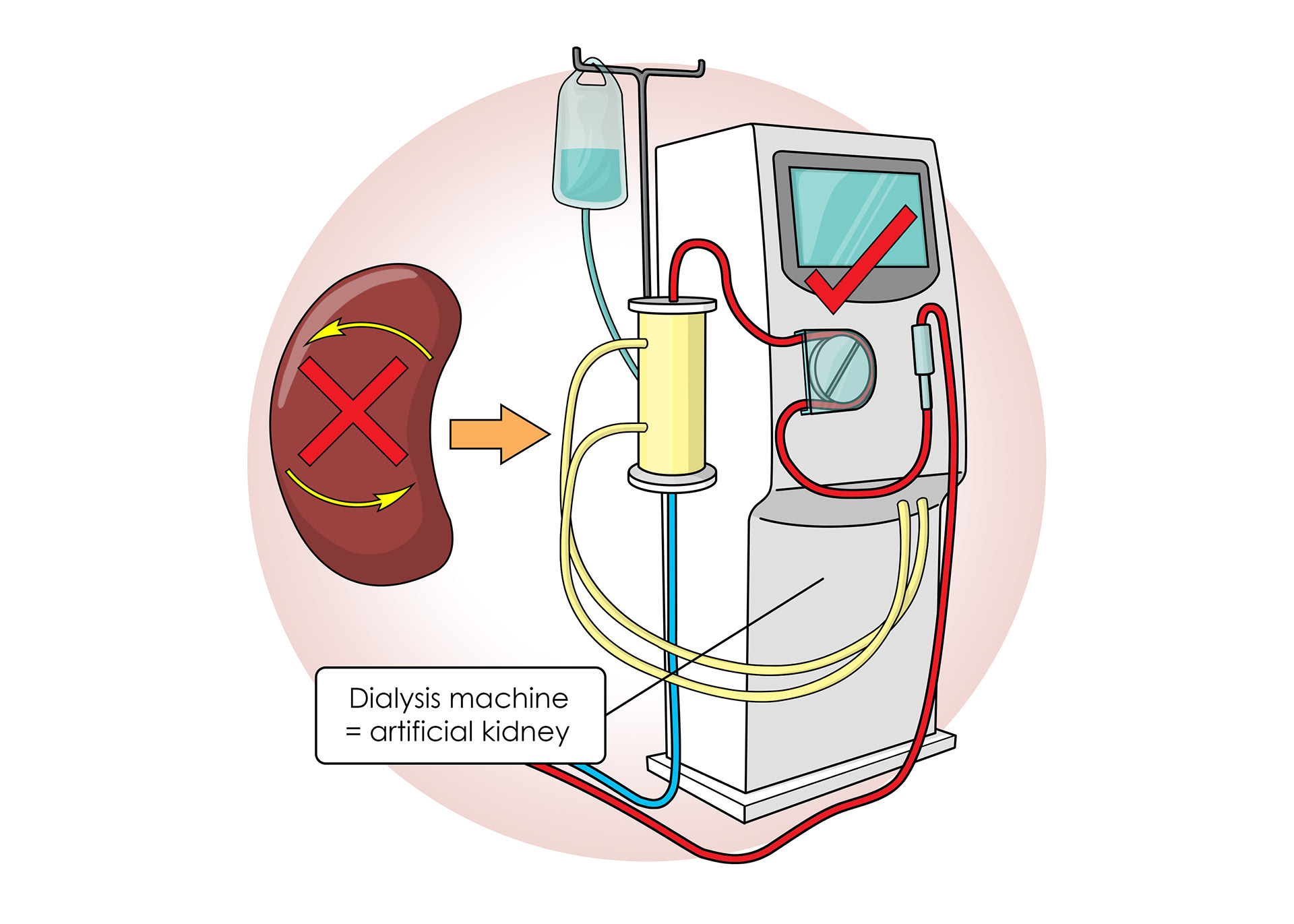 Dialysis machines - artificial kidneys